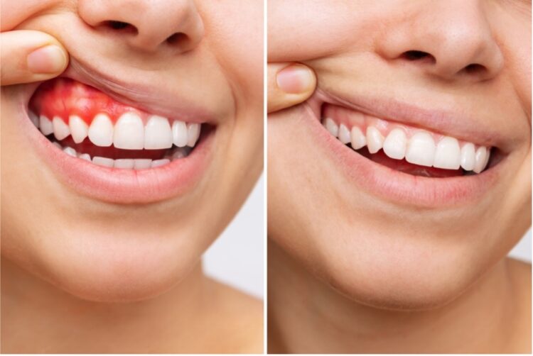 Healthy and unhealthy gums