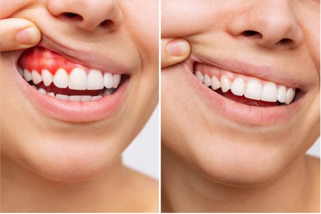 Healthy and unhealthy gums