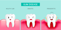 Why Gum Health is Important